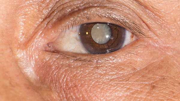 简析常见的青光眼的症状