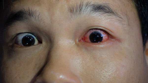 红眼病的病因是什么