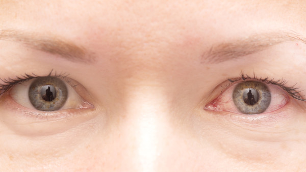 红眼病可以治愈吗