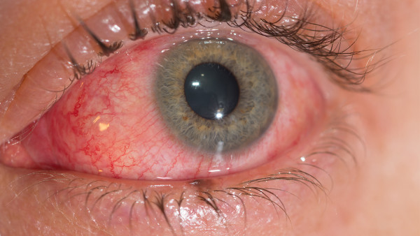 红眼病的护理应该怎么做
