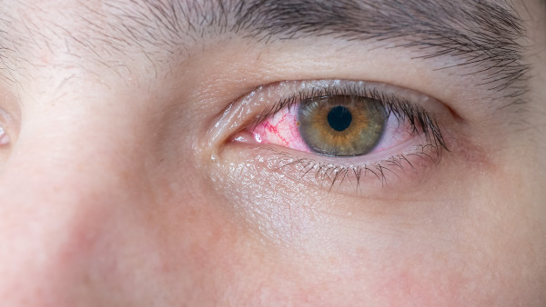 红眼病应该做哪些检查