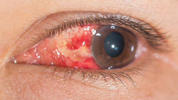 红眼病带来的常见危害
