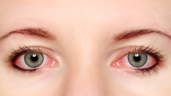 造成红眼病的病因有哪些