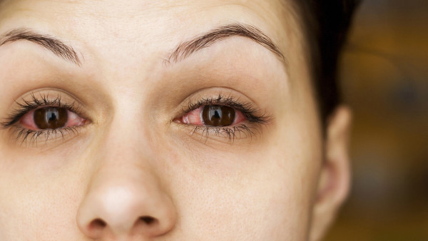 红眼病是怎么引起的