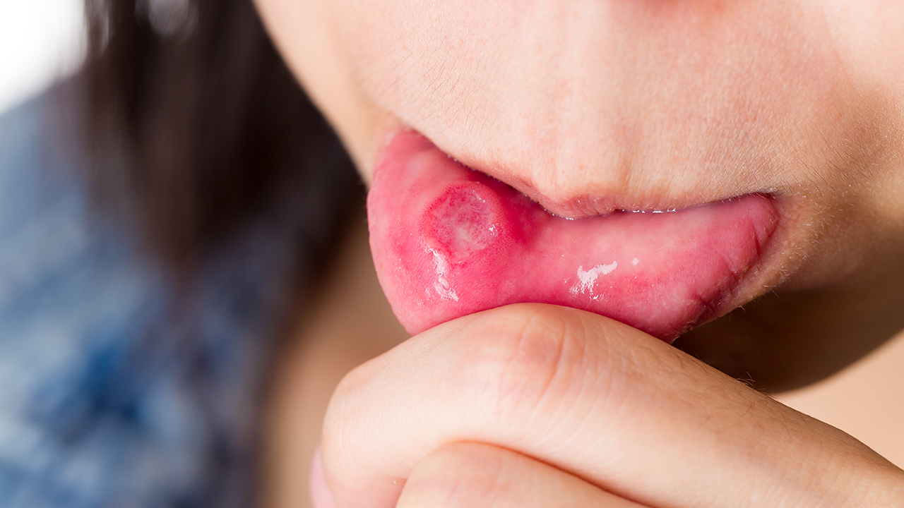 您知道經(jīng)常性口腔潰瘍?cè)趺崔k嗎?