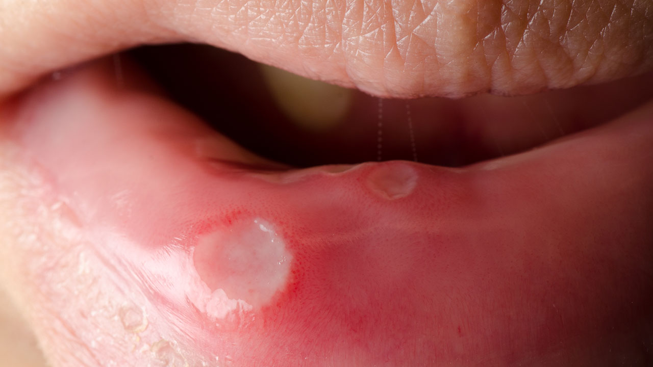预防唇炎发作的方法有哪些