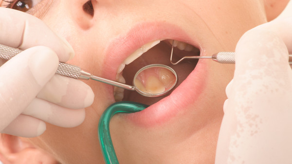 牙结石护理治疗方法有哪些