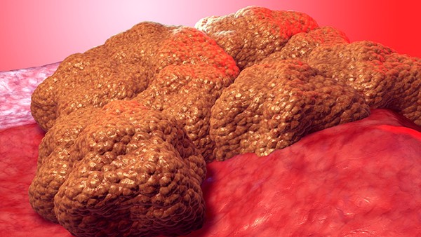 卵巢肿瘤可以用药物治疗吗