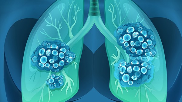 如何判断胆管癌是否治愈