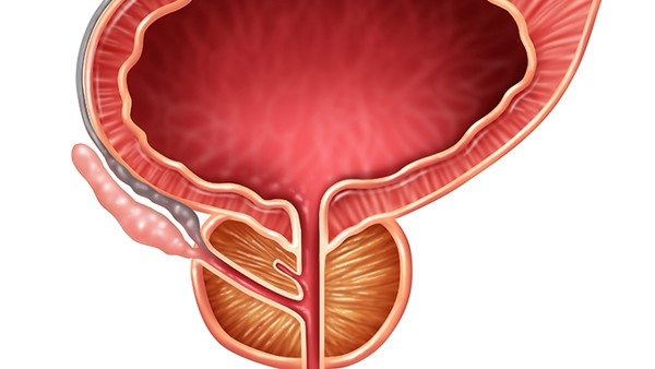 前列腺脓肿是怎么回事