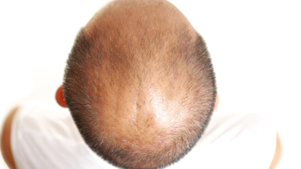 介绍几种预防秃顶的方法