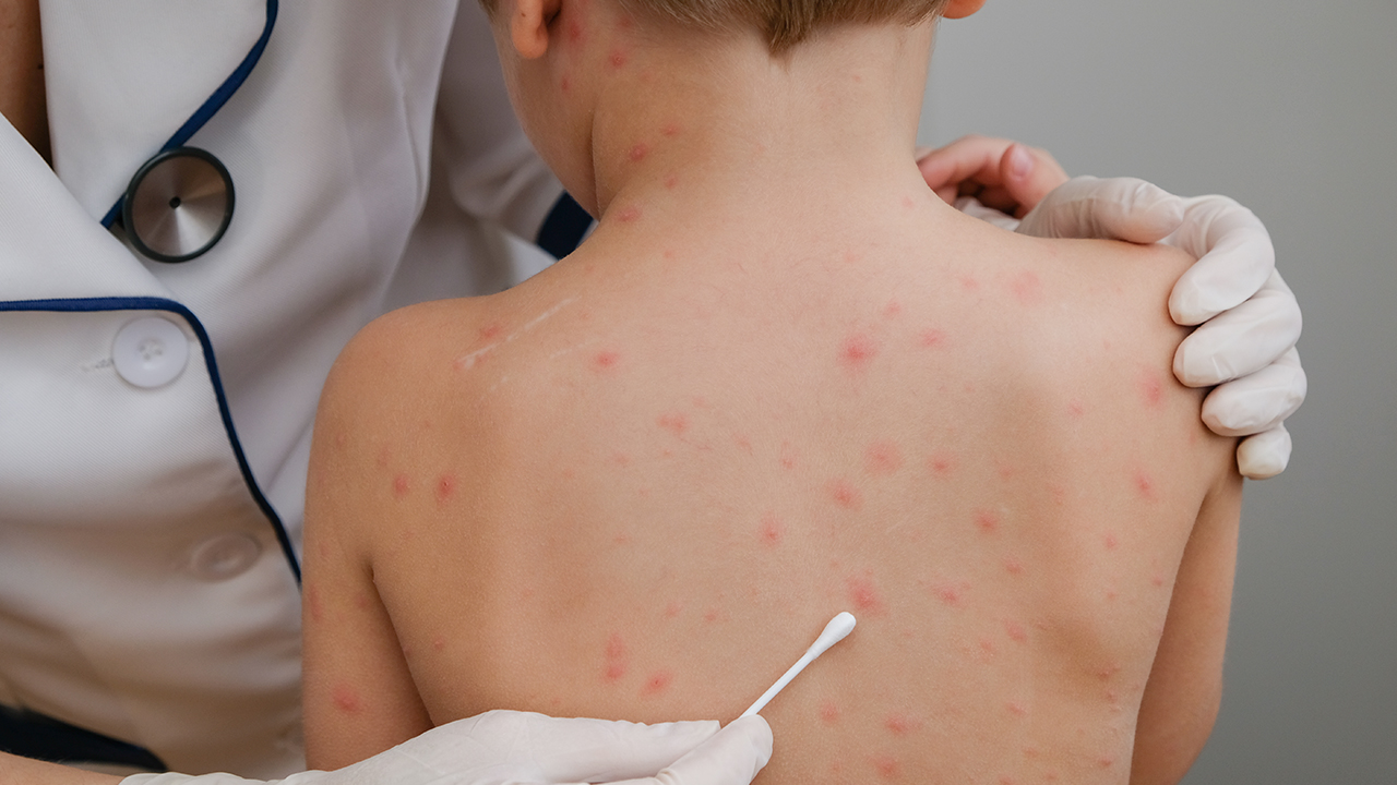 出现痒疹的原因是什么呢