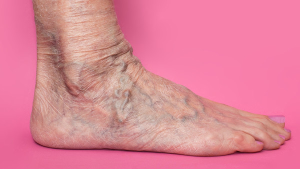脚气的危害表现是什么