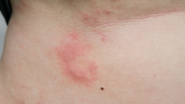 肛周湿疹是什么病