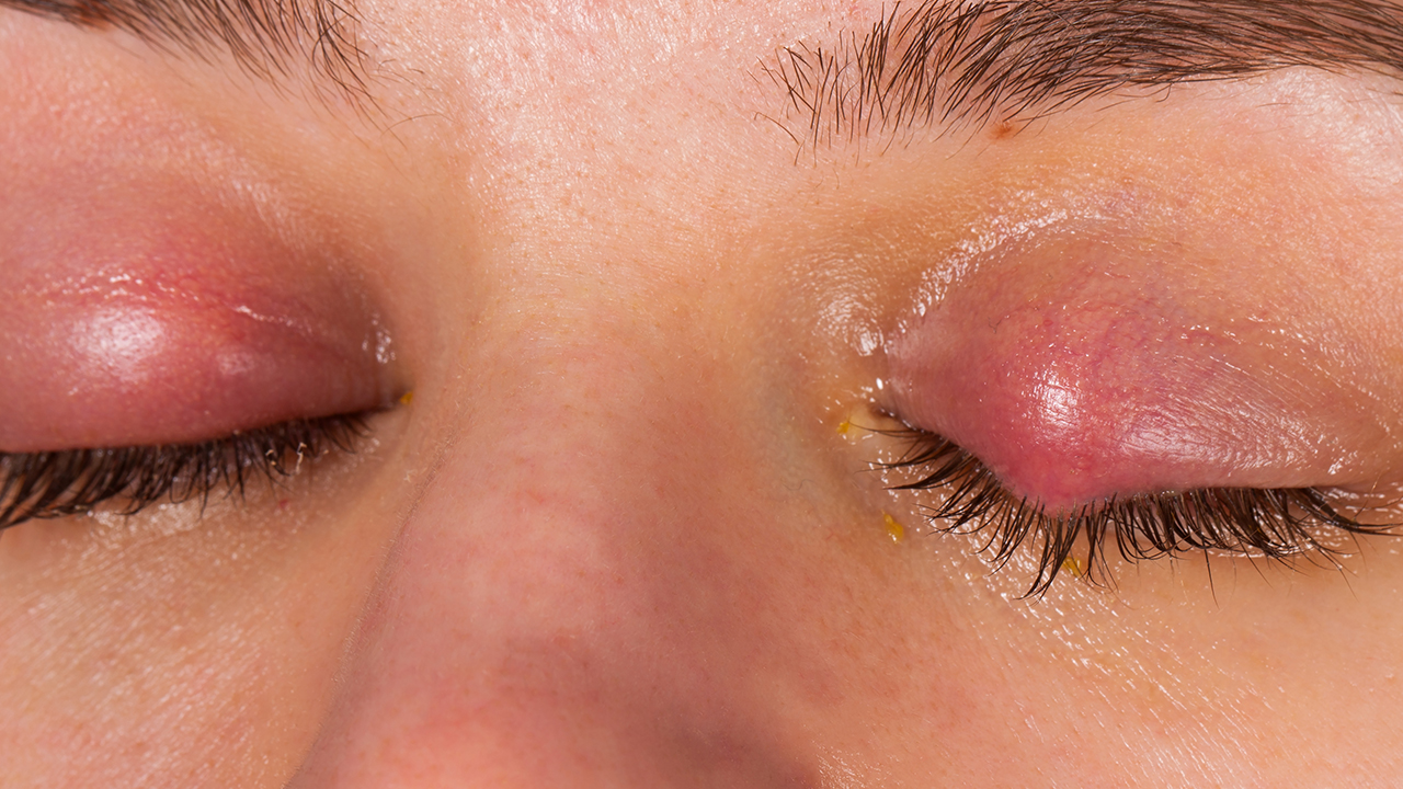 哪些是眼结石的综合症状表现