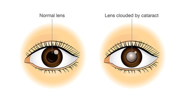 预防眼结石发作有什么方法