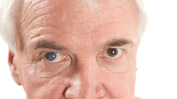 预防眼结石方法有哪些