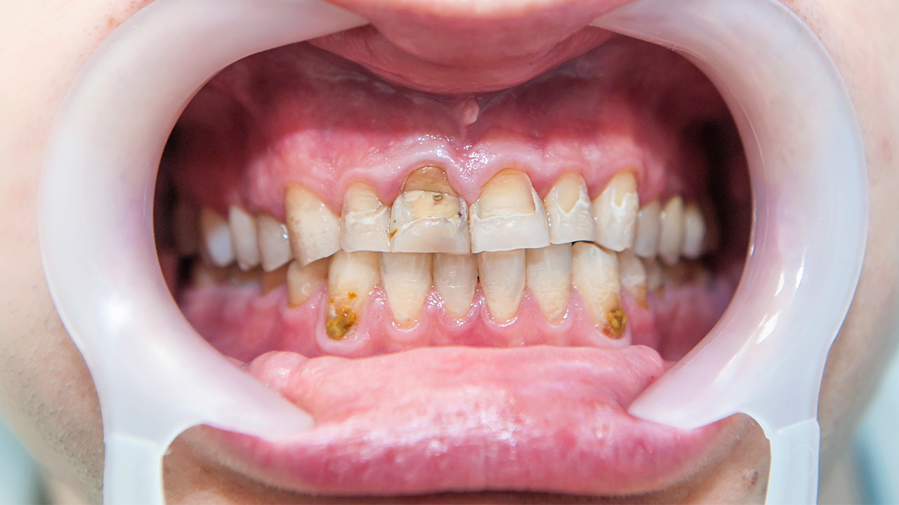 四环素牙一般怎么治疗呢