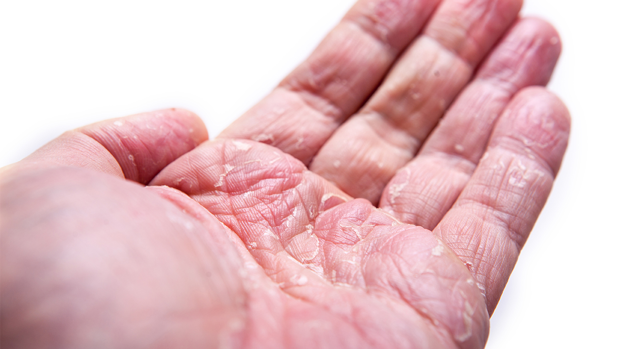 手癣疾病的基本概述