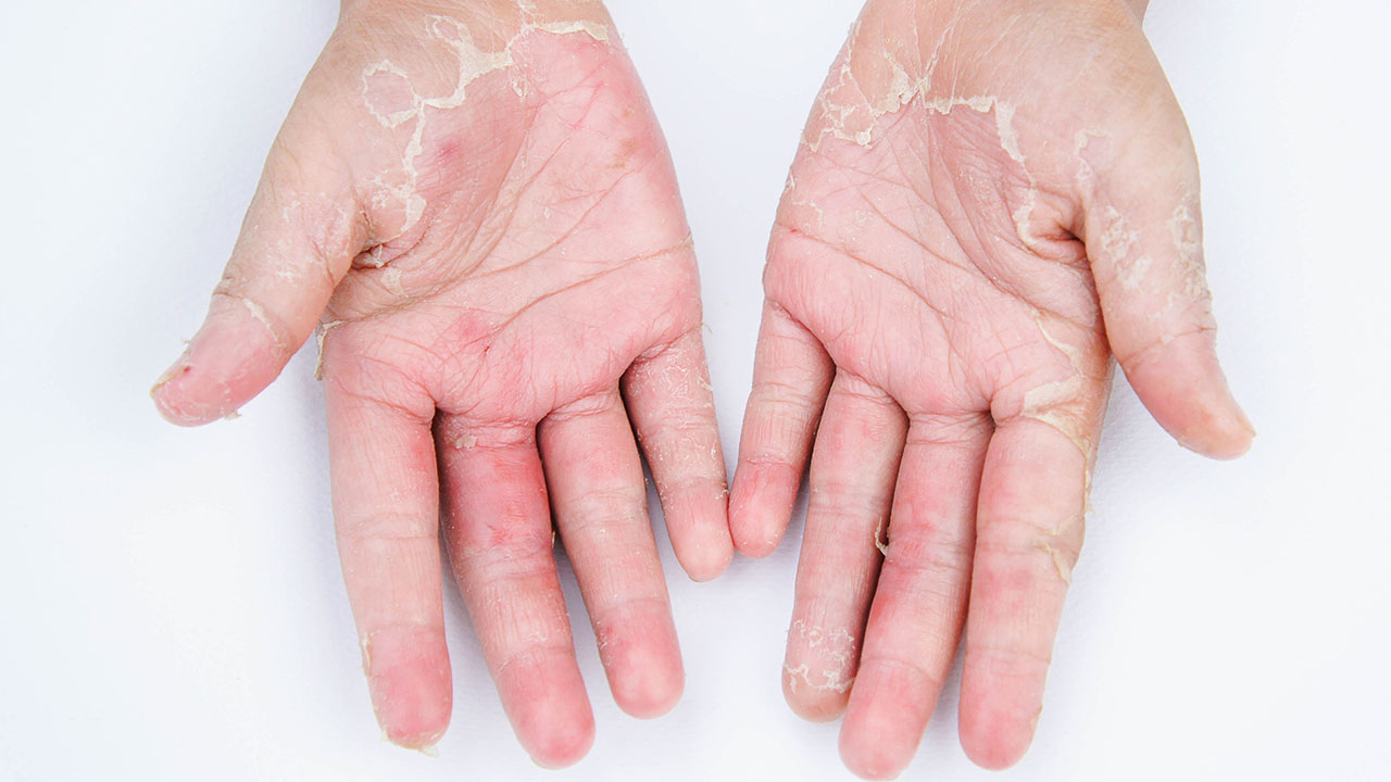 关于手汗症如何检查