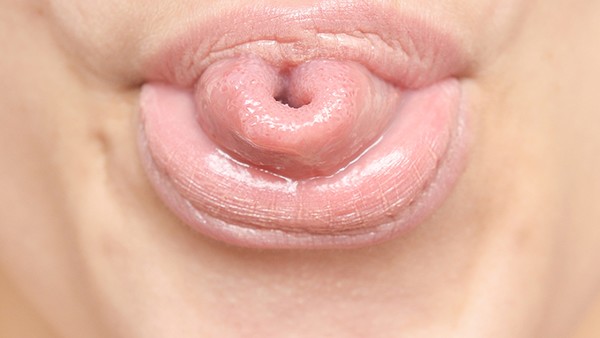 口唇疱疹有传染倾向吗