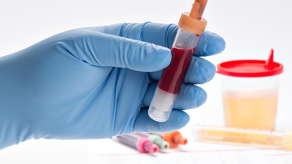 影响血脂检查的结果有五大因素