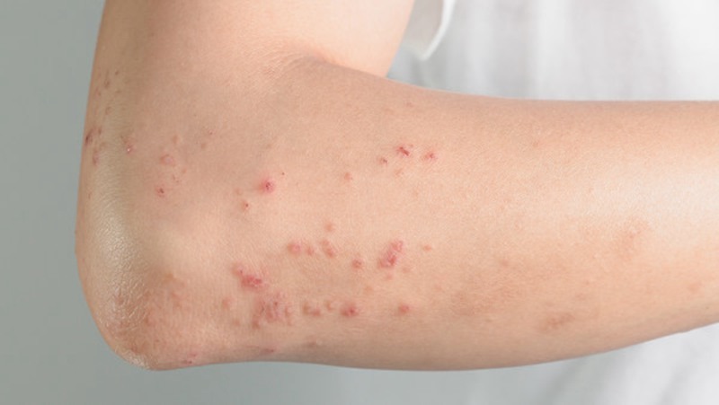 湿疹是什么引起的？怎么避免湿疹？