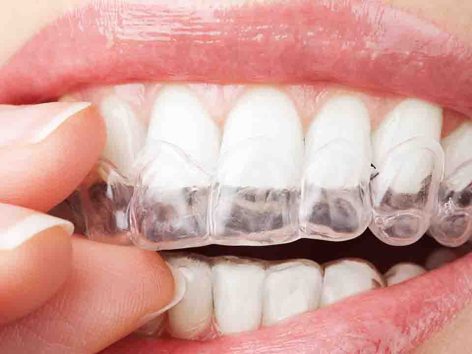 成年人矫正牙齿以后真的会掉光吗？