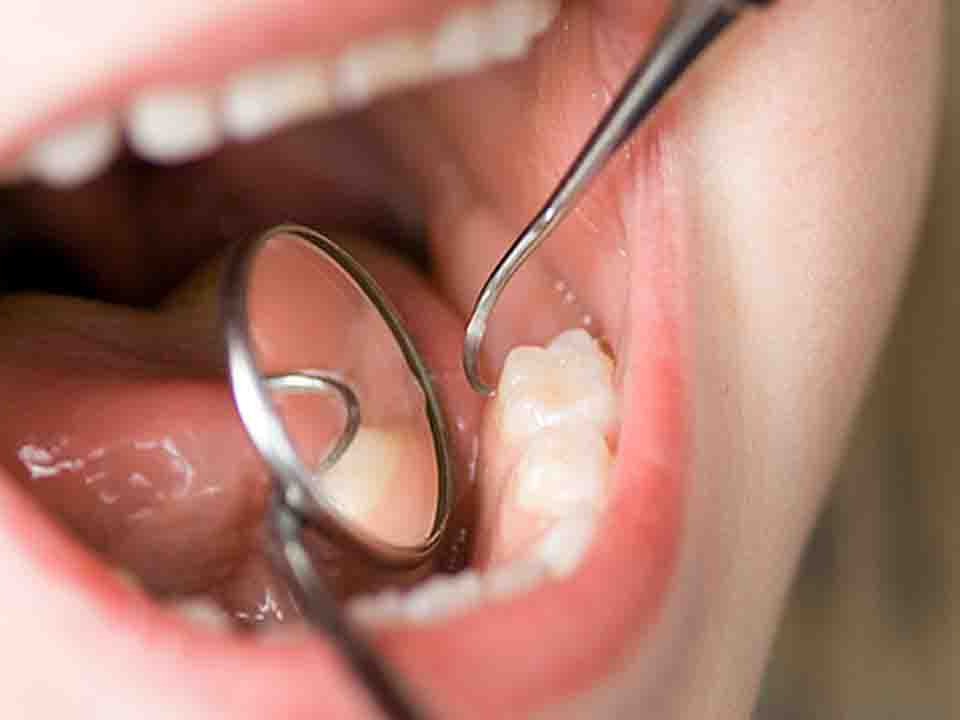 牙齿种植怎么做，直击种植牙过程