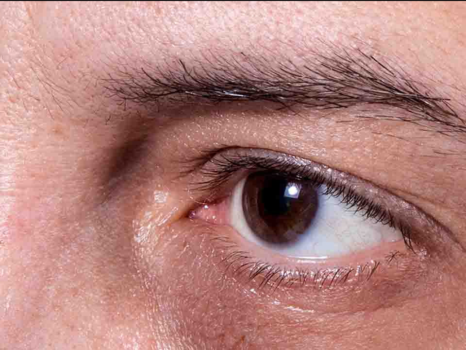 如何才能预防黑眼圈的出现