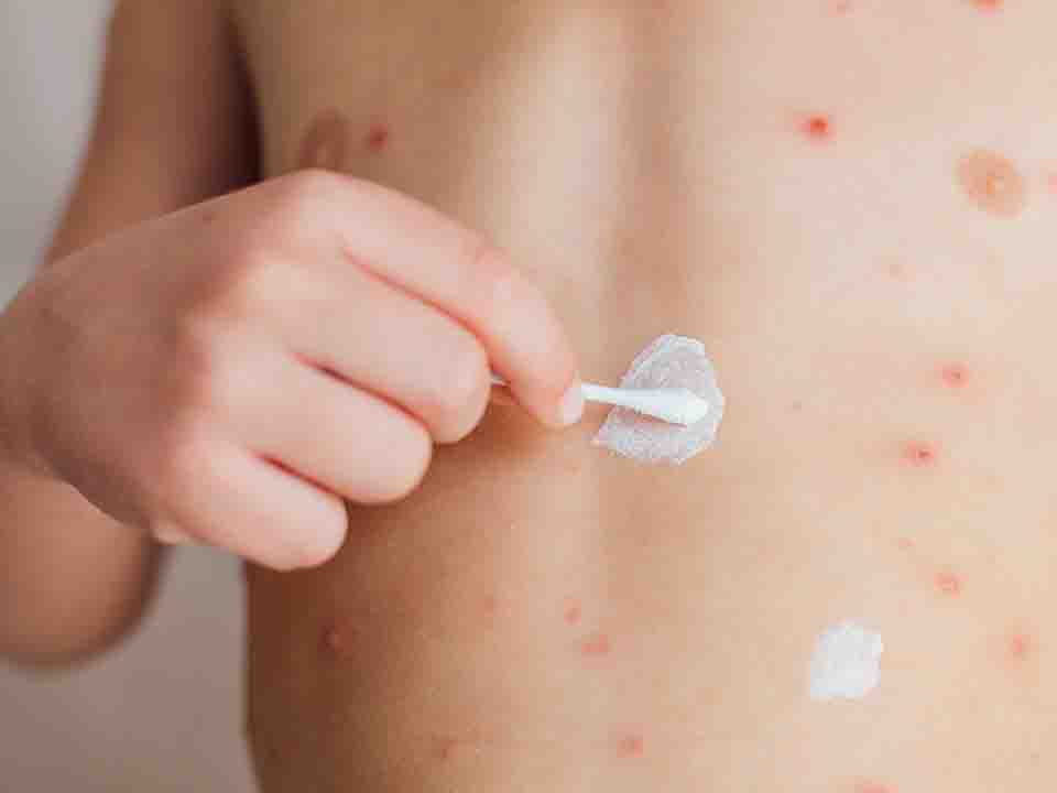 家长应该怎样做好荨麻疹患儿的护理措施