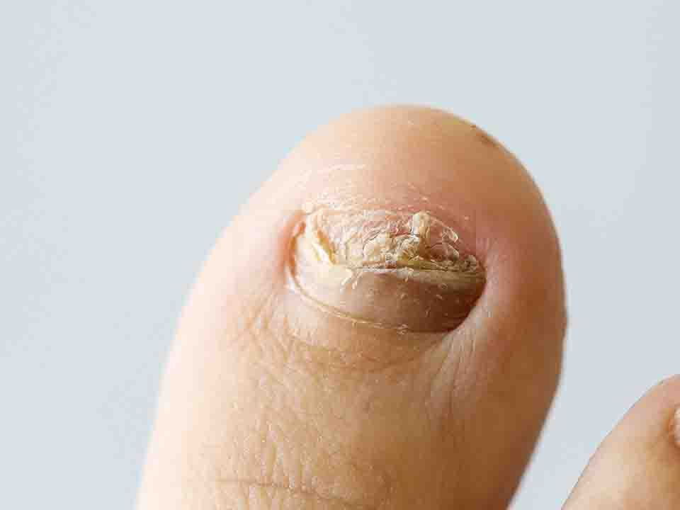 脚趾甲有灰指甲是什么症状