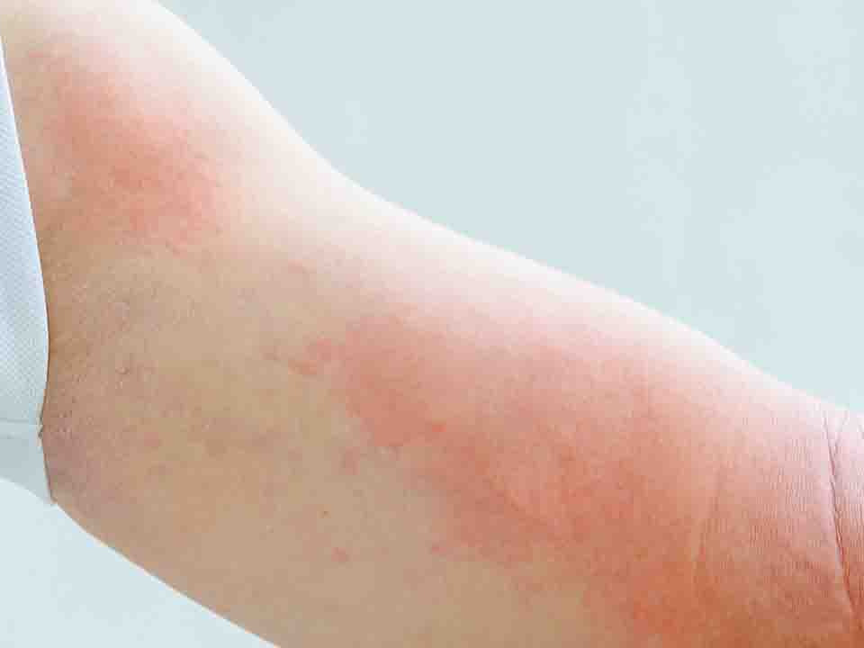 螨虫荨麻疹症状有哪些