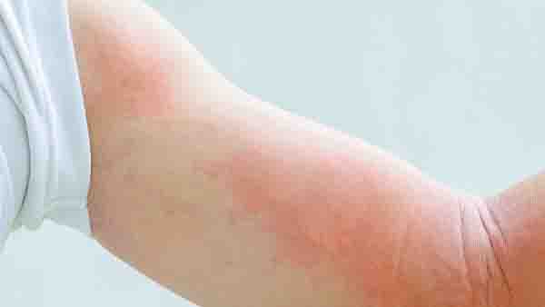什么是急性过敏性荨麻疹