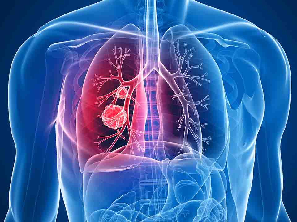 肺气肿的最佳治疗方法是什么