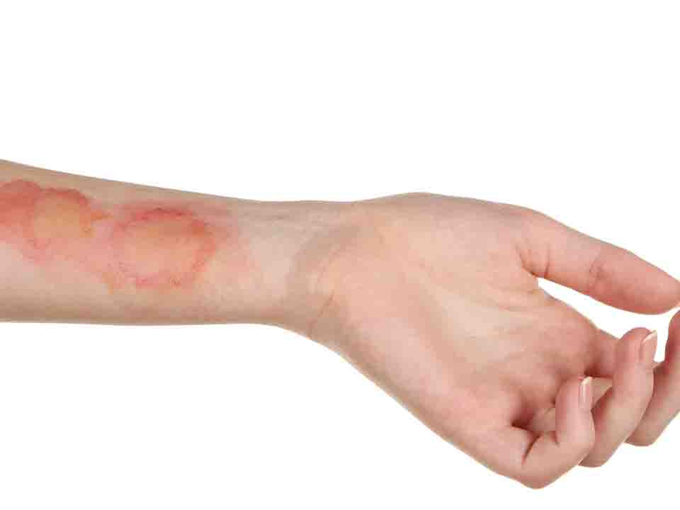 皮肤过敏是什么原因引起的？皮肤过敏症状