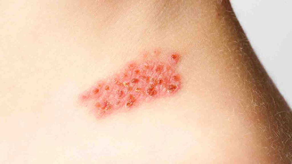 少年红皮病型牛皮癣手术治疗后会复发吗？