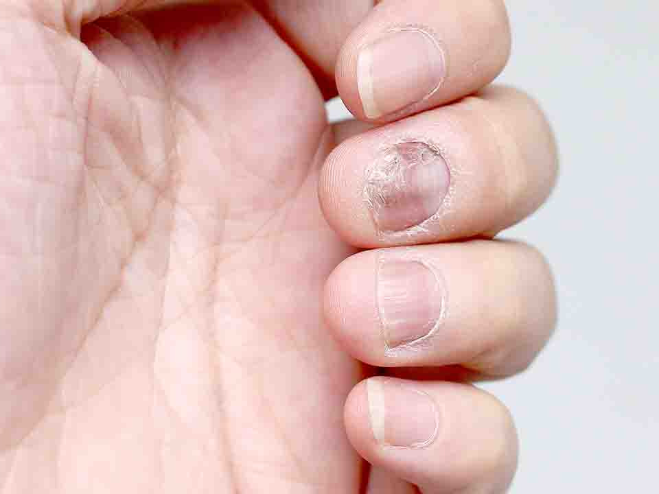治疗灰指甲有哪些特效药