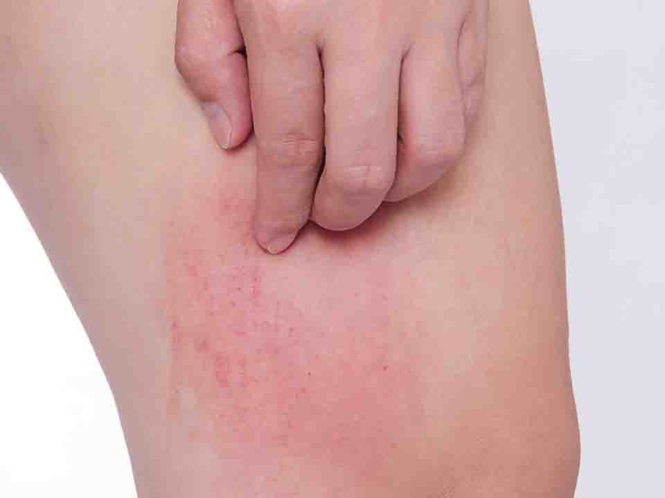 皮肤瘙痒的内外中药治疗方法是什么
