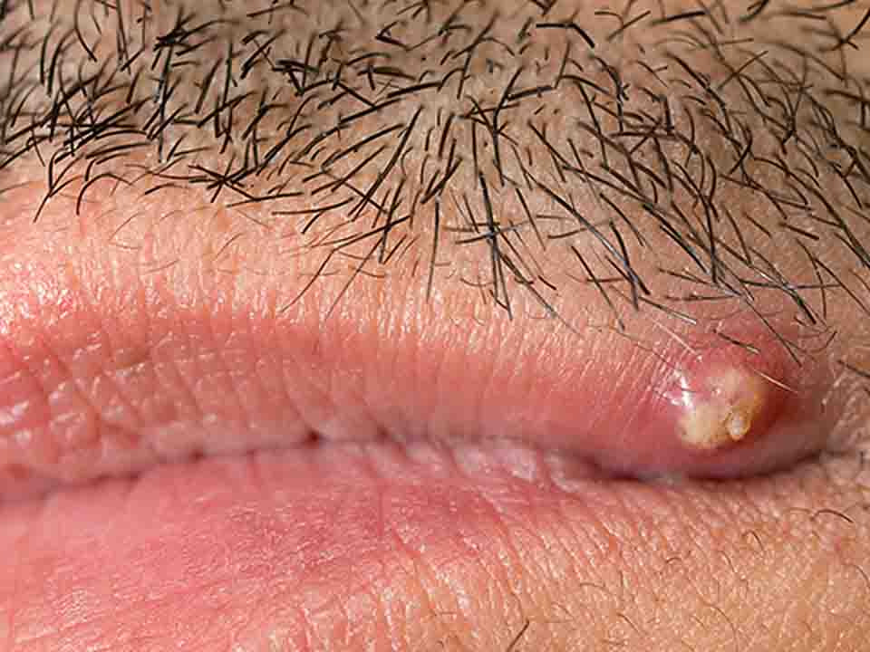 舌根口腔尖锐湿疣图片显示的症状