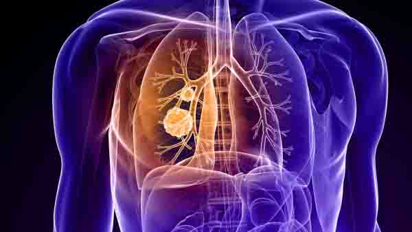 肺气肿最好的治疗方法都有哪些