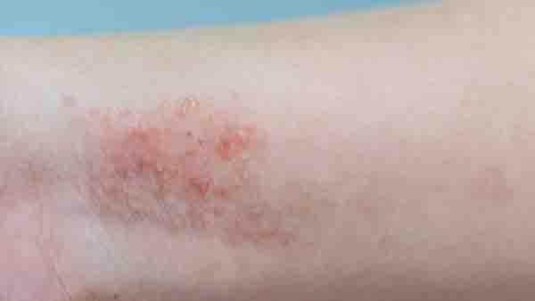引起过敏性皮炎湿疹的原因 过敏性皮炎与湿疹区别