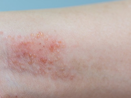 湿疹有什么症状？