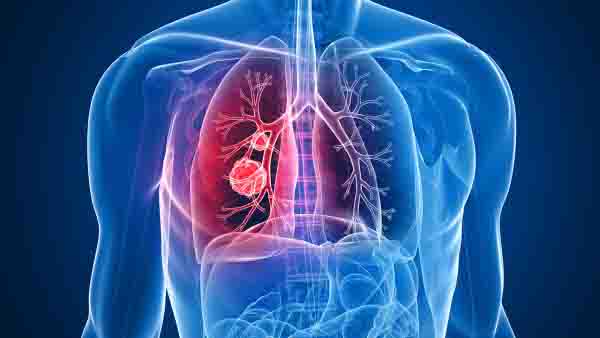 肺癌治疗一般花多少钱