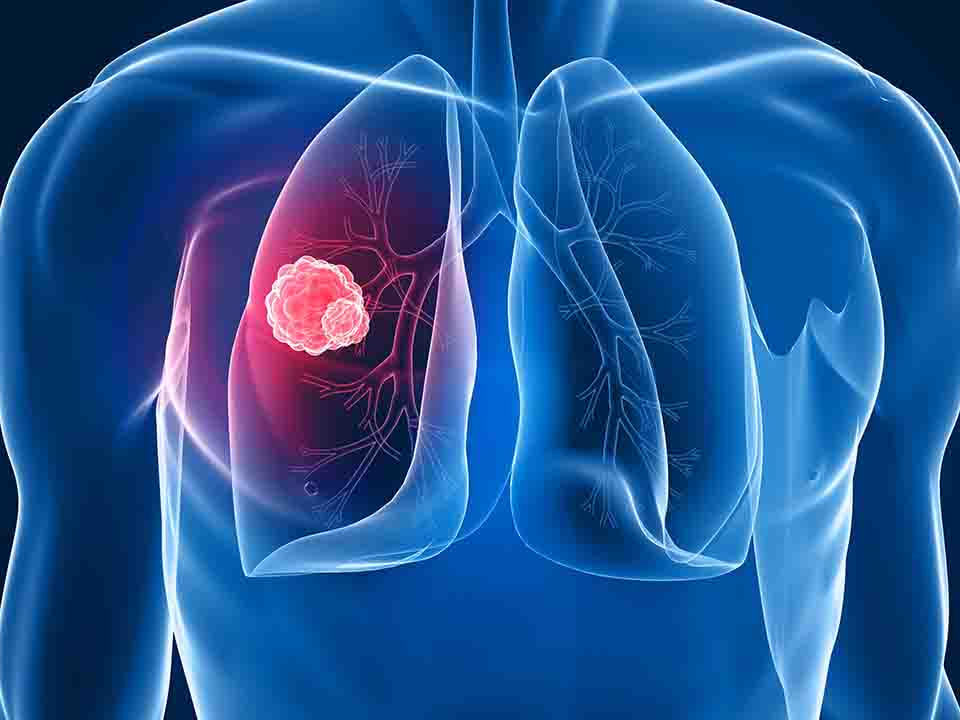 晚期小细胞肺癌能活多久