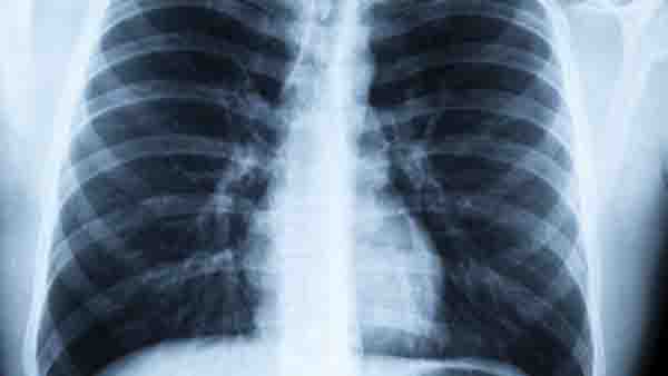 肺纤维化的ct表现有哪些