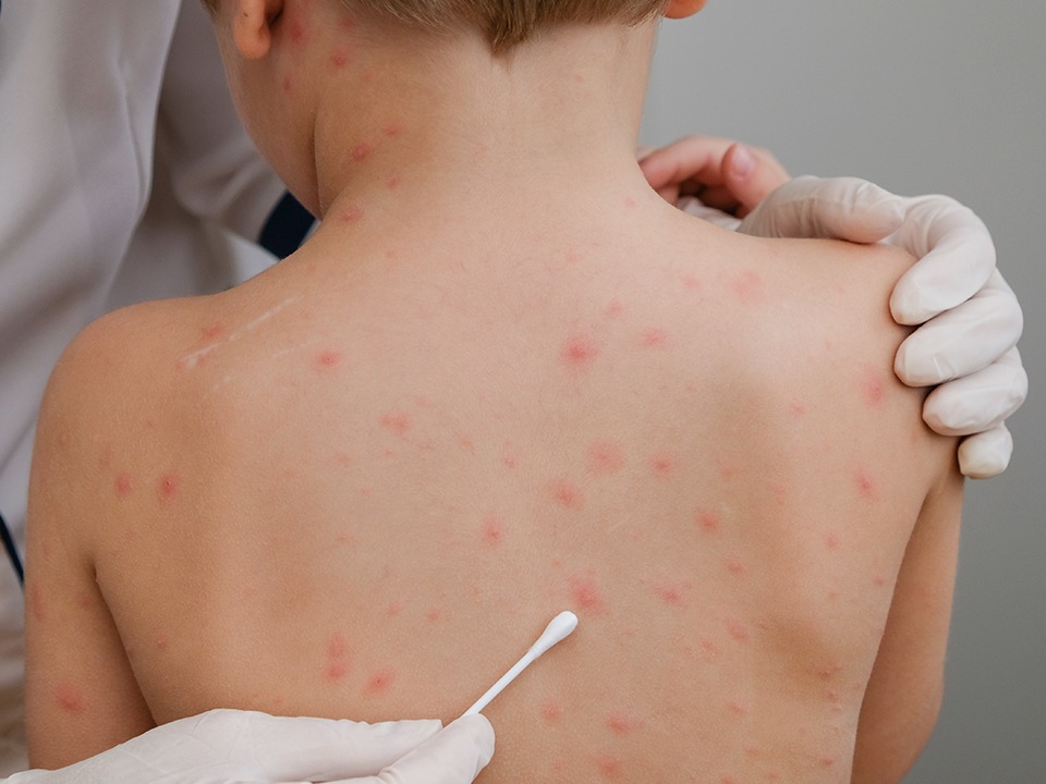 过敏性荨麻疹最快治疗方法是什么？