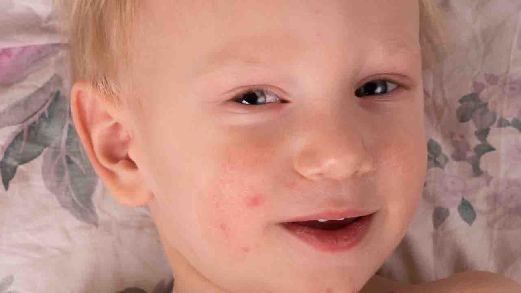 小儿荨麻疹治疗方法