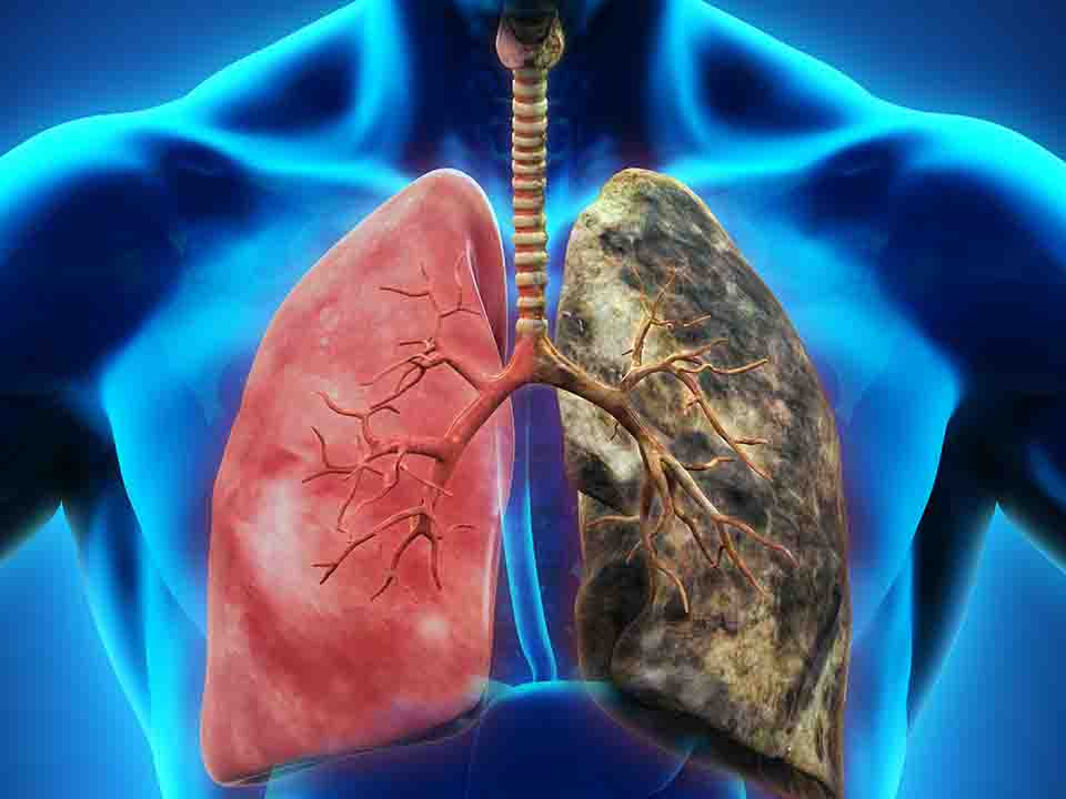 慢阻肺的诊断标准