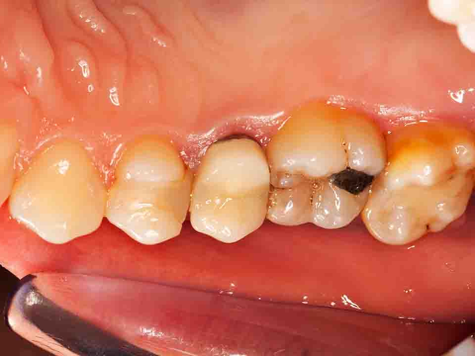 牙龈萎缩的主要症状表现有哪些
